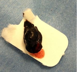 The bulk of the melanoma. 